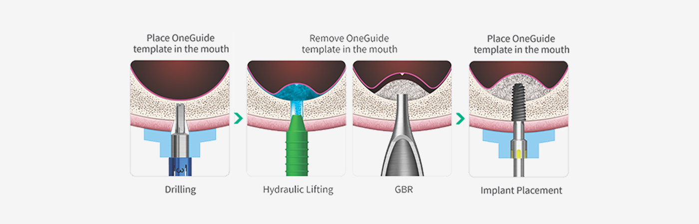OneGuide 备洞、液压窦提升、引导骨再生与种植体植入流程