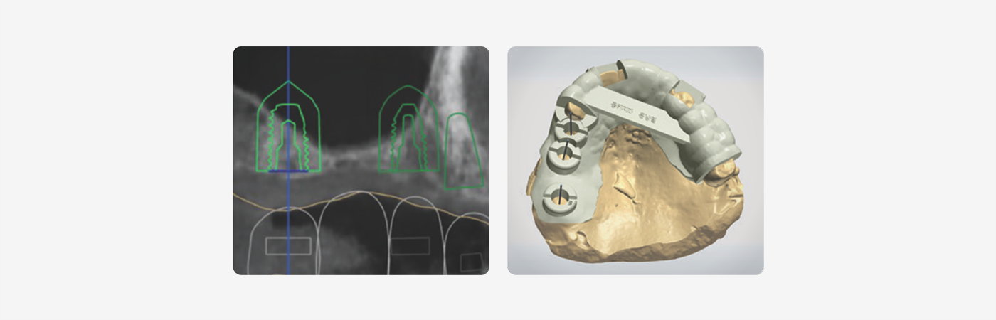 CBCT 种植规划与数字化模型上的个性化手术导板