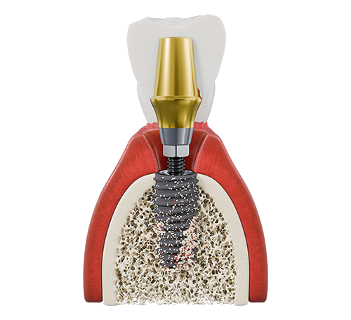 Select 优选系列 implant placed in an illustrated bone cross-section